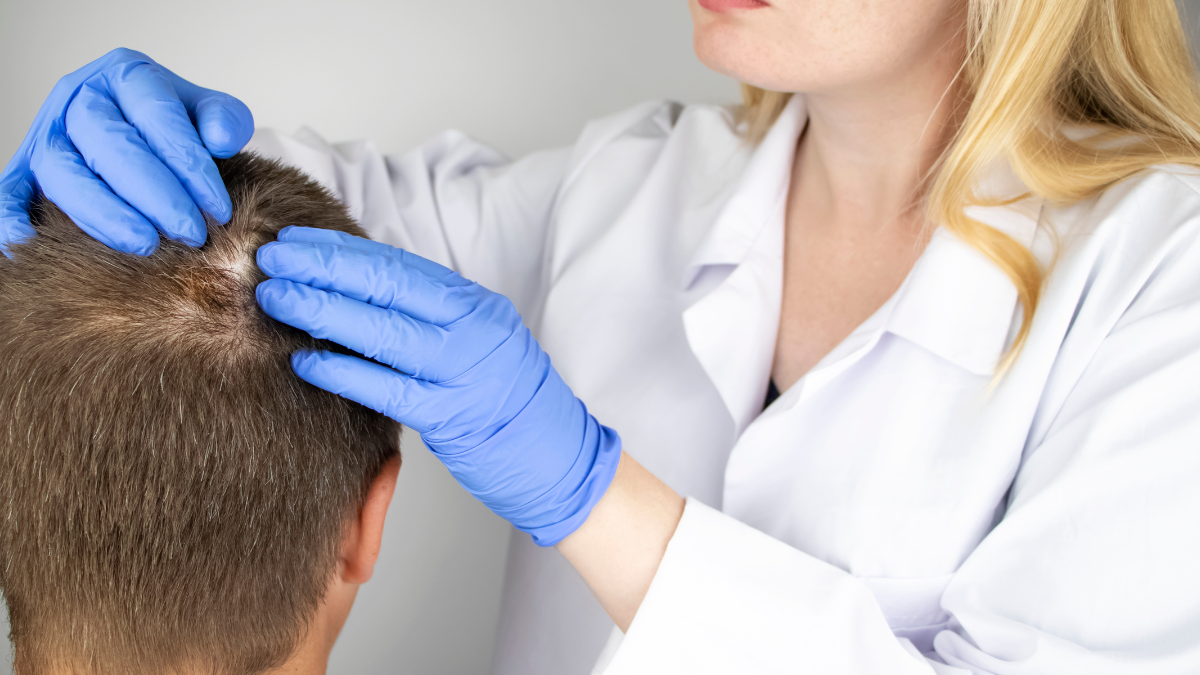 eliminar a calvície